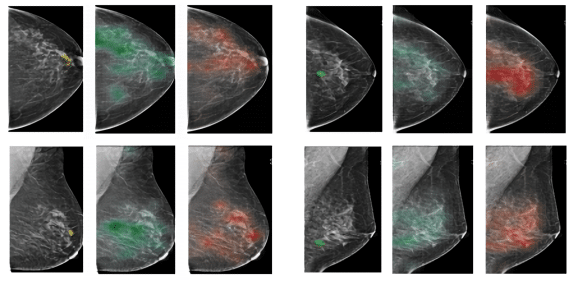 Inteligência Artificial é usada para detectar câncer de mama