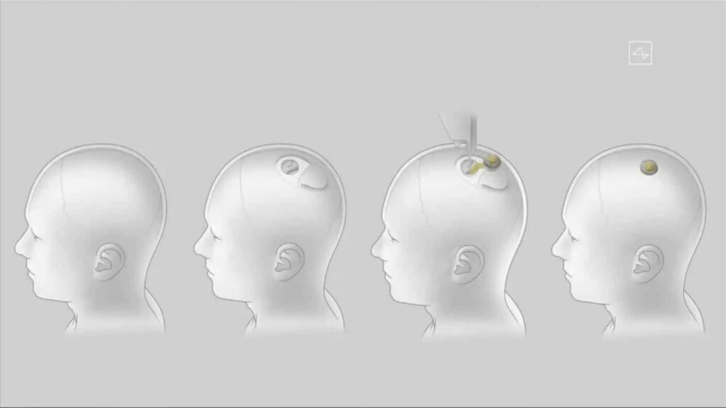fda-nega-pedido-de-neuralink-para-testar-implantes-cerebrais-em-humanos